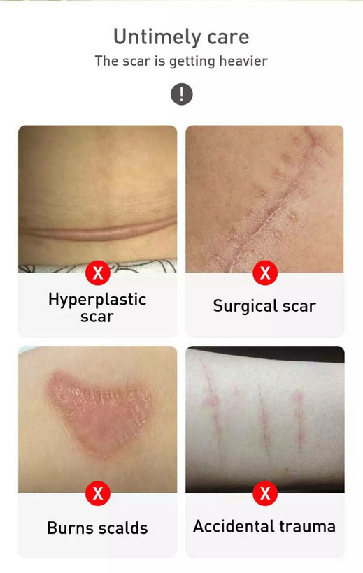 خرید اینترنتی ژل کرم تخصصی ترمیم کننده و رفع جای جوش و اسکار لانبنا